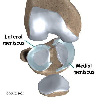Injuries: Meniscus Pathophysiology Tearing of either the medial