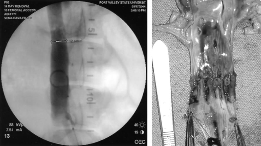 What does the IVC look like after a filter is removed?