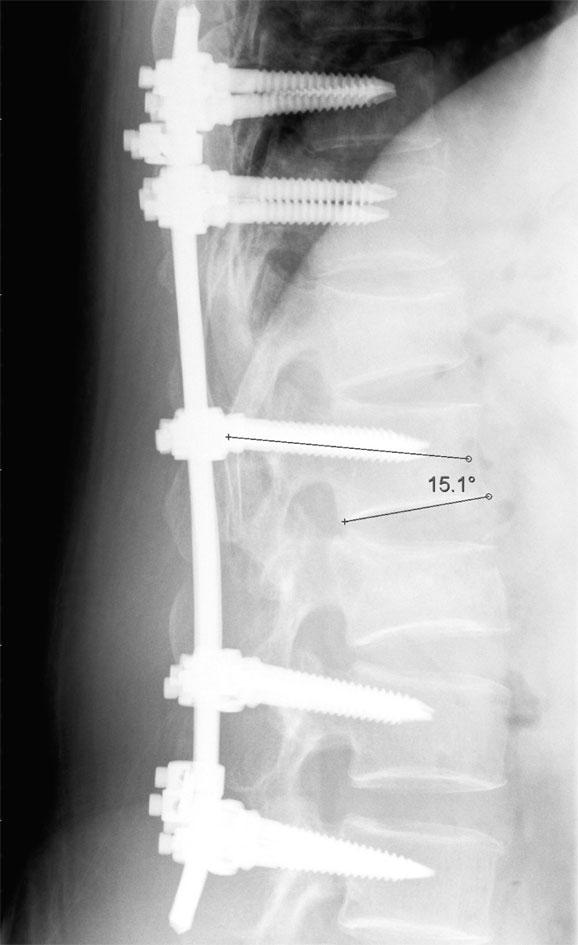 The pedicle screw is then inserted based on the guidance provided on the computer display of the system. Fig.