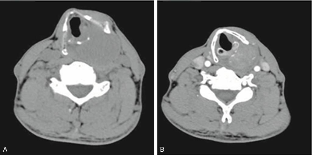 Figure 1. CT revealed a mass in the left pyriform sinus. A. A plain scan showed that the mass was homogenous; the CT value was set at 50 Hu. B.