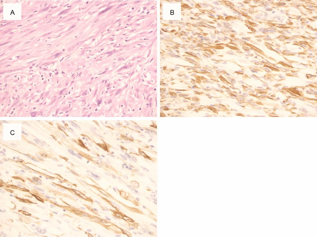 The pathological results indicated that the tumor consisted of atypical spindle cells, forming intersecting fascicles, and areas of strap-like cells, in which eosinophilic cytoplasm-mixed