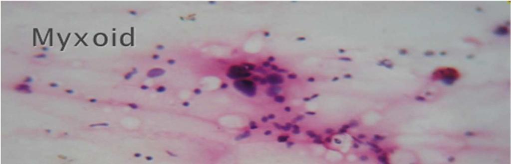 5 Advances in Cancer Research & Treatment Figure 4-Myxoid Sarcoma (H & E, 40 X) The subsequent histoplathological examination and special stain (PAS) confirmed cytologically diagnosed Small round