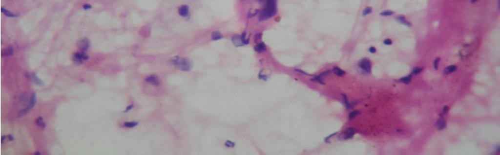 In our study, specific subtyping of malignant lesions on cytology posed the greatest challenge.