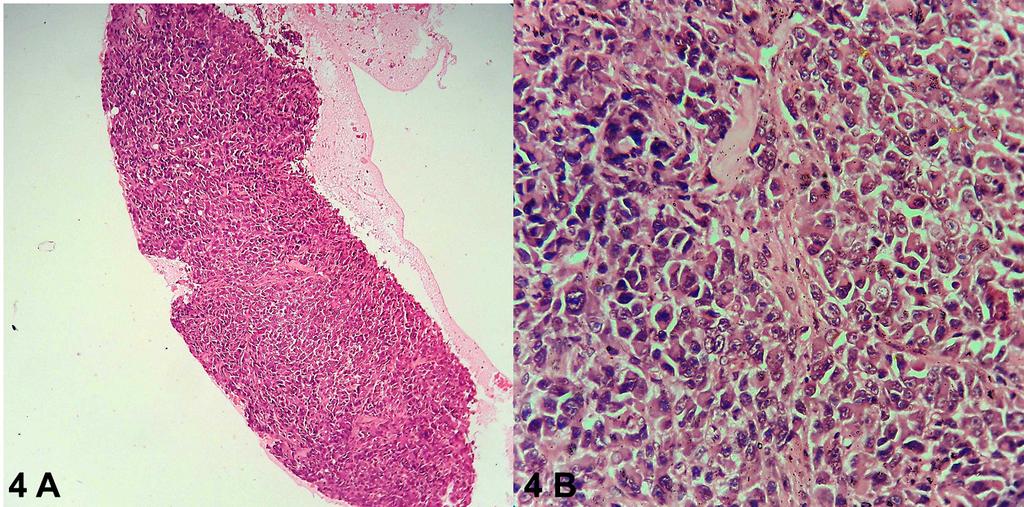 C-6 Clear Cell Sarcoma with Bone Marrow Metastasis Fig. 4: (A) Section showing near total replacement of bone marrow by sheets of tumour cells.