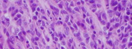 FINDINGS INTERPRETING FINDINGS IN A VACUUM THE USE OF EM IN THE DIAGNOSIS OF SPINDLE CELL / EPITHELIOID TUMORS Establish specific diagnosis