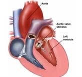 Aortic Stenosis Pathophysiology Compensatory Changes 58 Bicuspid Aortic Valve 59 Aortic Stenosis: