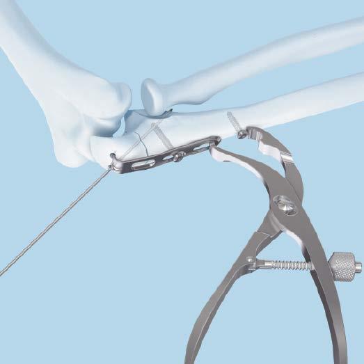 Insert Screws 6. Insert cortex screws continued Apply compression outside the plate using a bone holding forceps and the 3.5 mm cortex screw. Tighten the previously inserted 3.