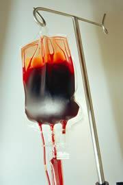 Transfusion therapy results in iron overload Transfusions 2 units/month 24 units/year ~ 100 units/4 years: 20 g iron 200 250 mg