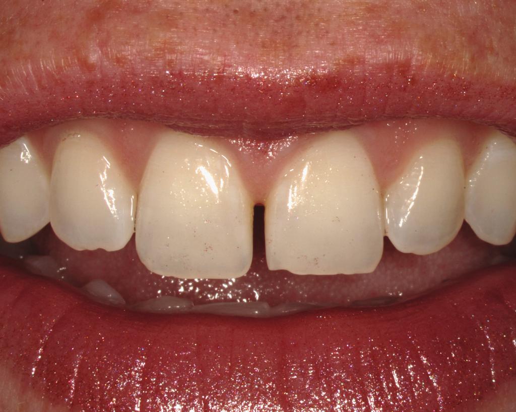 A Step-by-Step Approach to a Diastema Closure A Dual-Purpose Technique that Manages Black Triangles Marcos Vargas, DDS, MS Figure 1: Preoperative view of a patient who presented with a diastema
