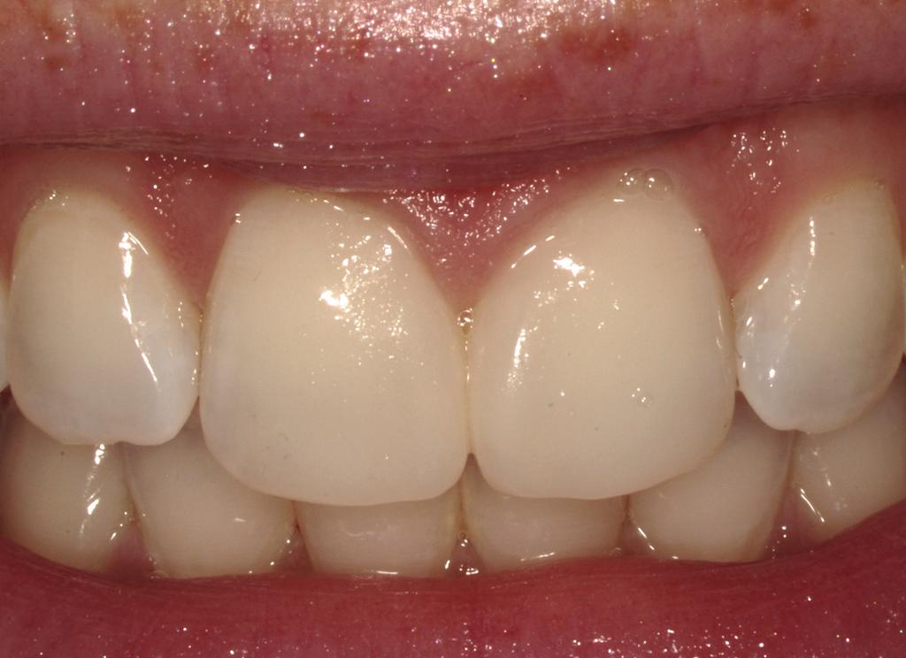 Vargas Following the step-by-step protocol described here will enable the dentist to successfully close the diastema, while taking into consideration those criteria necessary to create an ideal