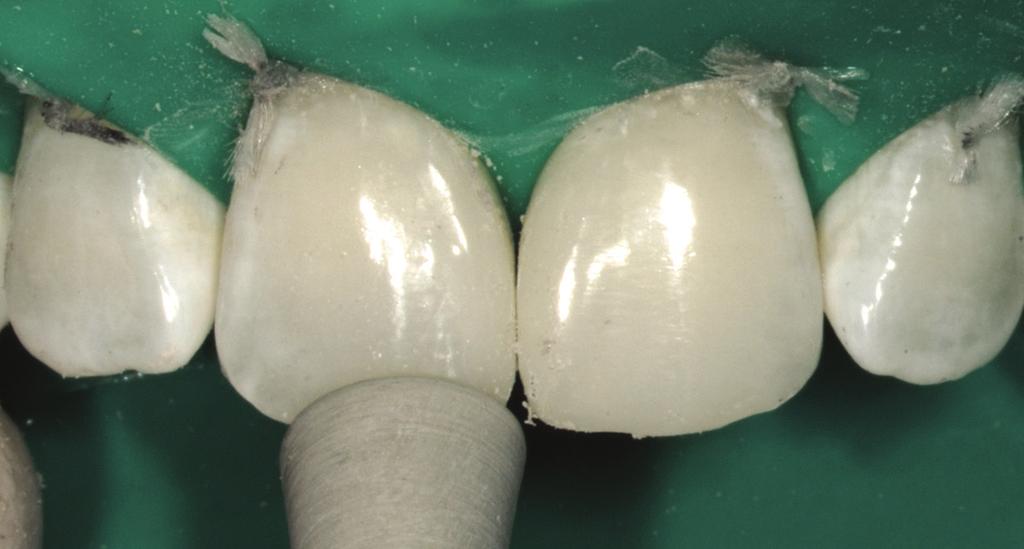 2 Although the success of a restorative treatment in anterior teeth depends on the esthetic integration between soft and hard tissues, direct restorative techniques can be applied to treat this