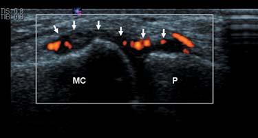 A. Ultrasound longitudinal on a tender joint in