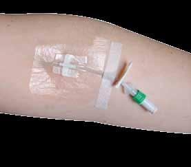 Line management is also enhanced by moving hub manipulation away from the insertion site, and reducing the risk of mechanical phlebitis, which can result in premature catheter failure.