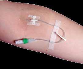 Features and Benefits Polyurethane catheter remains stiff during insertion but softens at body temperature, minimising vessel trauma and enhancing stay time.