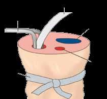 Cut the umbilical cord at its base, tangentially to the abdomen, remove any clots which may obstruct the vessel lumen. 3.