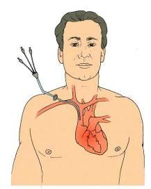 Non-Tunneling Central Venous Catheter (CVC) Short term use (days to several weeks).