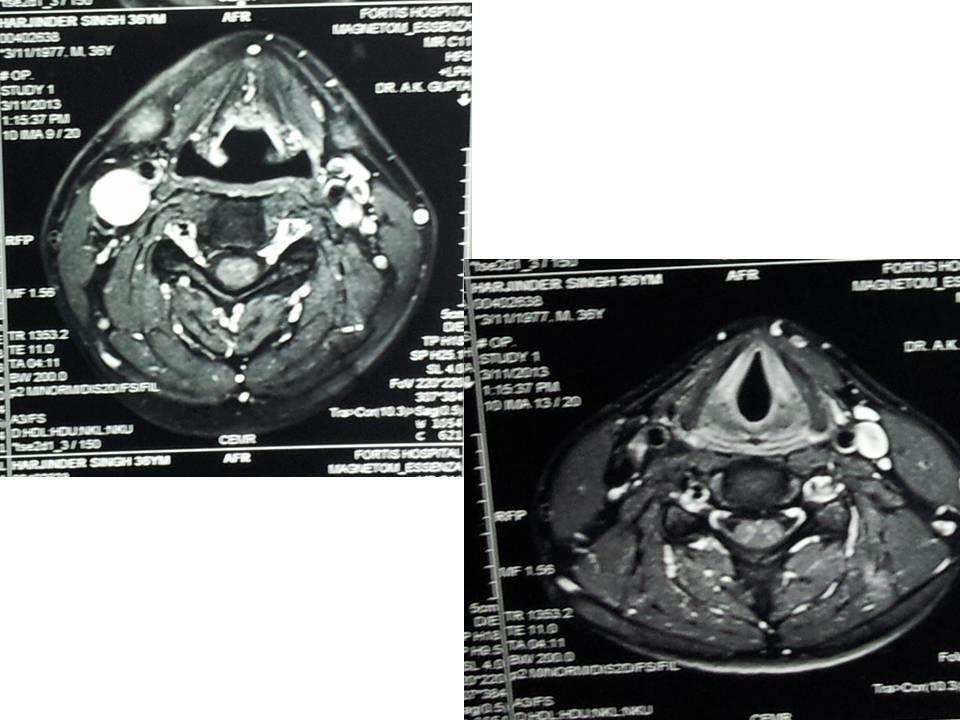 Fig 3 a and b) MRI showing T1 and T2 weighted showing