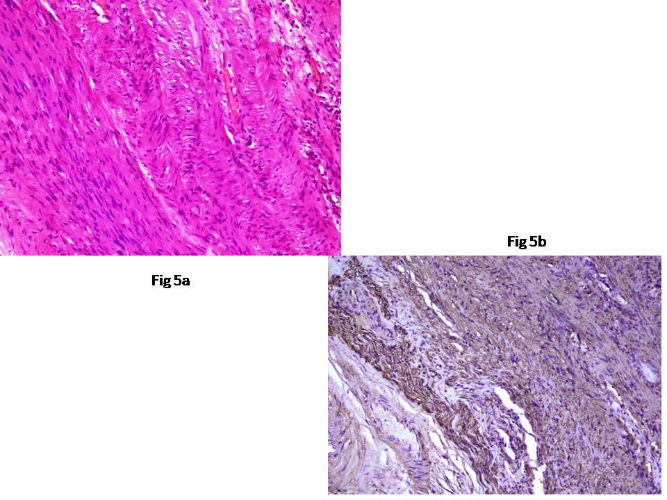 Fig 5: Histopathology 5a): H$E stain: hypocellular and hypercellular areas showing typically spindle shaped