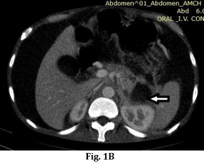 Mesenteric venous thrombosis: Diagnosis & Non Invasive imaging. Radiographics 2002; 22: 527-5411. 8. Kaufman LB, Yeh BM, Breiman RS, Joe BN, Qayyum A, Coakley FV.