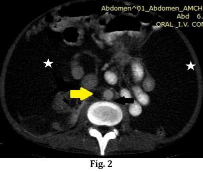 Figure 2: CECT Abdomen axial image showing complete luminal occlusion of IVC (yellow arrow) & normally filled Aorta (black