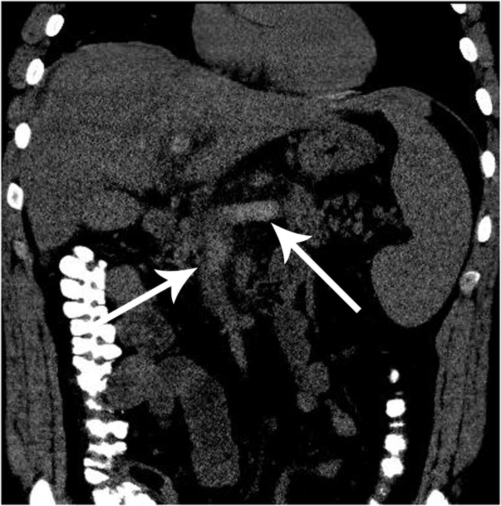 Fig. 6: Splenic, portal and superior mesenteric vein thrombosis at unenhanced CT axial and coronal images on standard abdominal windows