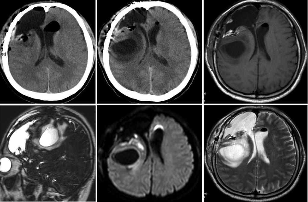 3 Consecutive postopertive neuroimging. Computed tomogrphy (CT) scn on 4 th dy fter the surgery shows no cyst formtion (). CT nd MRI on the 7th dy fter the surgery revels remote cyst formtion ( f).