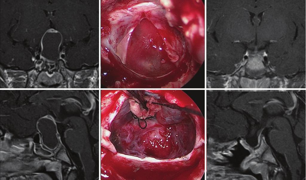 Gadolinium-enhanced coronal (a and e) and sagittal (b and f) magnetic resonance images before (a and b) and after (e and f) surgery. Intraoperative view before (c) and after tumor removal (d).