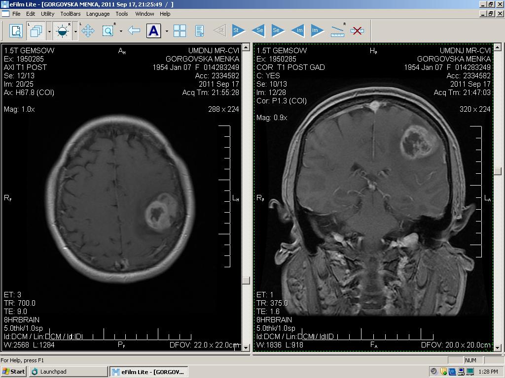 I am going to use the malignant brain tumor glioblastoma (GBM) as an example of cancers