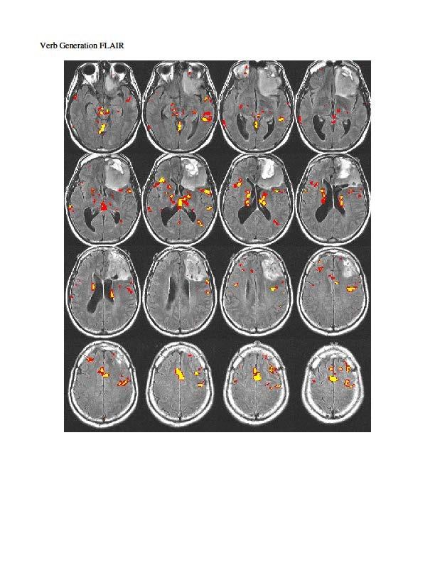 We obtained a functional MRI that mapped the language area out on the MRI of the patient.