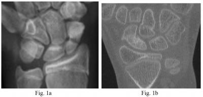 Figure 1 Evidence of non-union 7 months after the initial injury a) Plain A-P radiograph, b) CT image Operative technique The fractures were fixed with a minimally invasive percutaneous technique