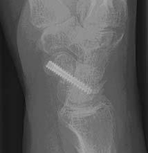 Figure 1.5 Scaphoid radiographs of the right hand of a patient with a scaphoid fracture who had a percutaneous screw fixation.