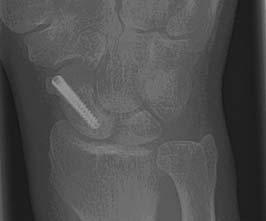 Seven years after a consolidated (conservatively treated) scaphoid fracture, 11% of patients were complaining of loss of strength, 10% of pain when moving, 6% of loss of functionality and 3% of pain