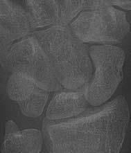 (b) MR imaging in the acute phase (less than 24 hours after trauma) showing a scaphoid fracture. (c) Bone scintigraphy (more than 72 hours after trauma) showing a scaphoid fracture.