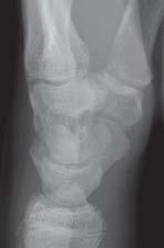 Because no fracture was visible, no further diagnostics were performed and the patient was treated functionally.