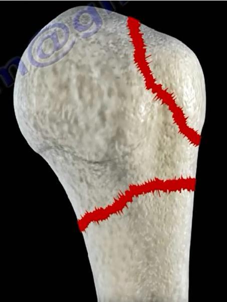 Humerus Fractures Proximal Humerus Neer Classification o Simple: non-displaced two part & three part fractures --- treated with sling.