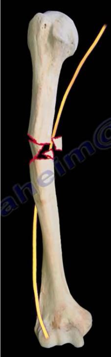 Humeral Shaft Fractures Look for RADIAL NERVE INJURY and WRIST DROP (unable to extend the wrist and fingers and sensory loss on the dorsum of the base of the