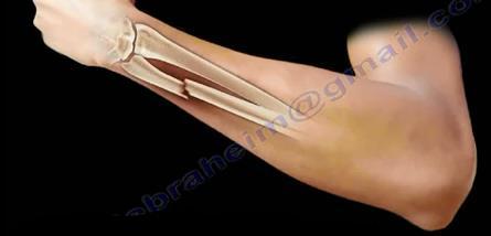 Forearm Fractures Monteggia Fracture-Dislocation Fractures of proximal third of the ulna with