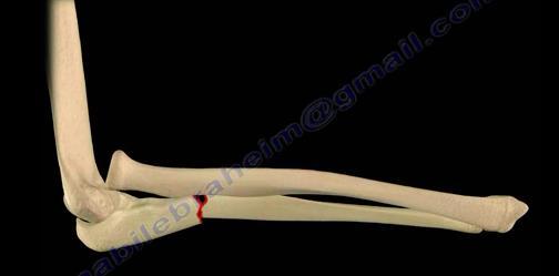 Treatment: open reduction and internal fixation of the ulna and closed reduction of the radial head.