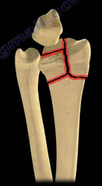 Wrist Fractures Fractures of the Distal Radius Look for MEDIAN NERVE COMPRESSION.