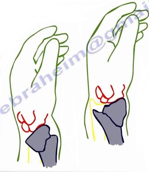 Smith Fracture Definition: Extra-articular fracture of the distal end of the radius with volar displacement of the distal fragment.