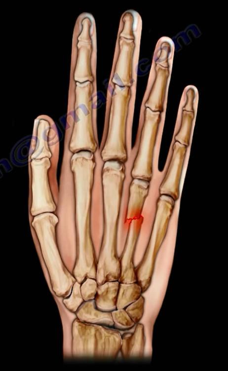 o Complete articular: Rolando s Fracture can be treated with ORIF, closed reduction, percutaneous pinning or external fixation.