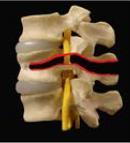 Thoracolumbar Spine Fractures Fractures of the Thoracolumbar Spine o Compression and burst fractures without neurological deficit will utilize