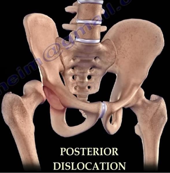 and internally rotated o Anterior dislocation: rare-lower limb will be extended, abducted and externally rotated.