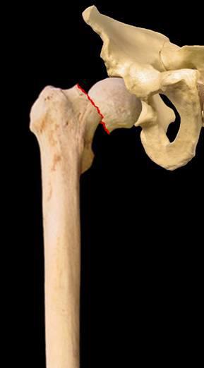 Proximal Femur Fractures Femoral Neck Fractures HIGH RISK OF AVASCULAR NECROSIS HIGH
