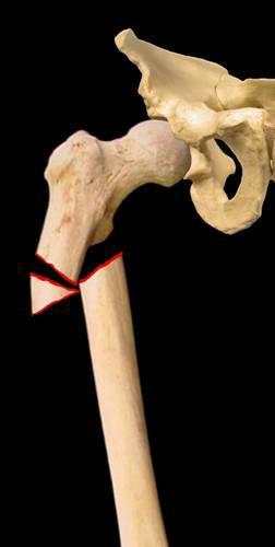 Reverse Oblique Hip Fracture Treatment with a rod, plate or blade plate.