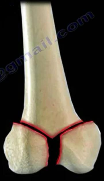 Fractures of the Distal Femur Treatment: o Supracondylar Fracture: above the knee joint and will require surgery. o Intercondylar Fracture: involves the knee joint.
