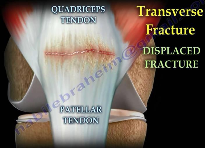 Fractures of the Patella Results in the disruption of the extensor mechanism of the knee. The patient is unable to extend the knee.