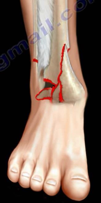 Fractures of the Tibial Plafond (Pilon Fracture) High risk of soft tissue complications SOFT TISSUE CONDITION SHOULD BE CAREFULLY ASSESSED.