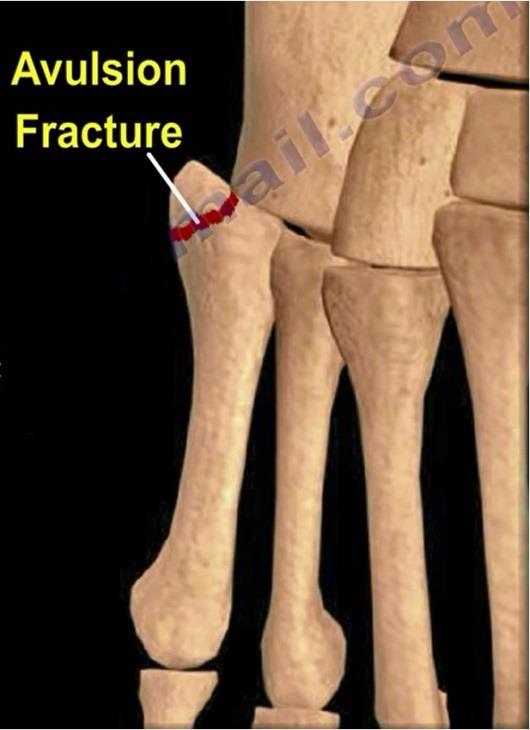 Fractures of the proximal fifth metatarsal Avulsion fracture, a zone I injury usually occurs along the insertion of the lateral band of the plantar aponeurosis or avulsion of the peroneus brevis.