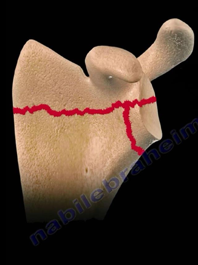 Scapula Scapula is surrounded by strong muscles and injury to the scapula requires a great force that can injure the chest. Be aware of the possibility of an ASSOCIATED PNEUMOTHORAX.